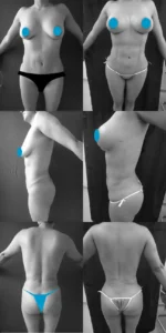 LIPOLISIS-MARCACION-AB-LIPOINYECCION-G-PEXIA-MAMARIA-PERI-IMPLANTE