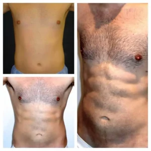 MARCACION-DE-ABDOMINALES-BOGOTA-COLOMBIA-3