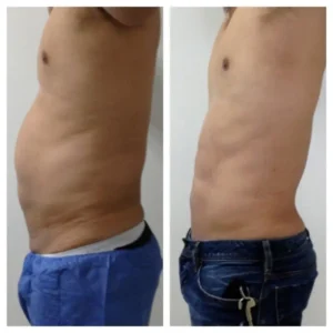 MARCACION-DE-ABDOMINALES-BOGOTA-COLOMBIA-4