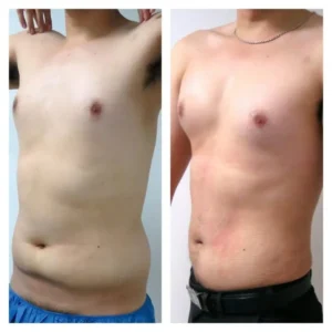 MARCACION-DE-ABDOMINALES-BOGOTA-COLOMBIA-5