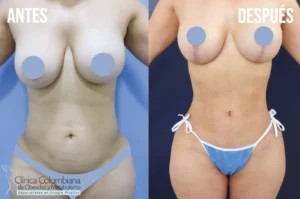 Vista frontal del torso en posición T mostrando lipolisis laser resultados de definición abdominal.