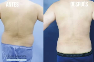 Moldeado integral del torso en posición T con lipolisis laser resultados equilibrados y naturales.