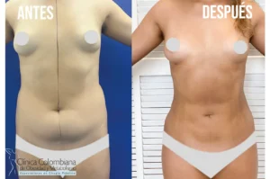 Silueta del torso redefinida gracias a lipolisis laser resultados postoperatorios visibles.
