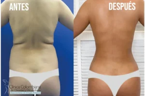 Reducción de volumen en los laterales del torso, lipolisis laser resultados de silueta estilizada.