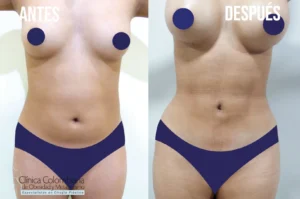 Evolución del contorno abdominal mostrando lipolisis laser resultados estéticos y simétricos.
