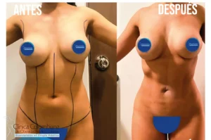Comparativa de abdomen frontal mostrando lipolisis laser resultados de definición.