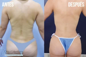 Aspecto final del torso tras el procedimiento, lipolisis laser resultados de piel tensa y contorneada.