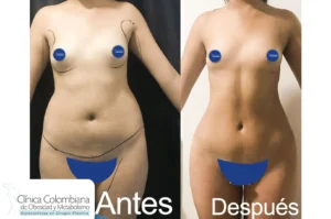 Perspectiva diagonal del área abdominal para apreciar lipolisis laser resultados de moldeado integral.