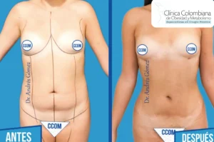 Comparativa de abdomen bajo donde se observan lipolisis laser resultados de tonificación y firmeza.