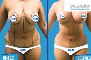 Vista frontal de torso esculpido con lipolisis laser resultados de alta precisión en la zona media.