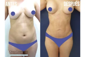 Reducción de medidas en el contorno del torso, lipolisis laser resultados de retracción cutánea óptima.
