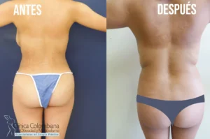 Zona de los brazos con lipolisis laser resultados notables en firmeza.