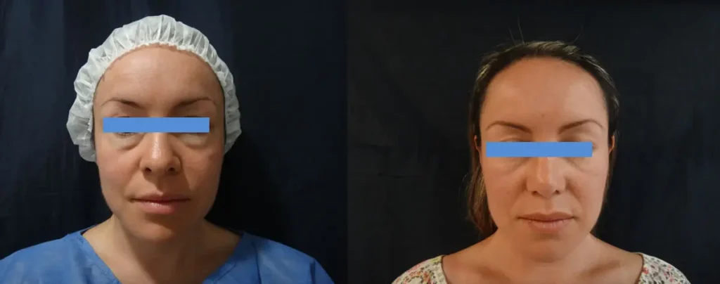 RINOPLASTIA-Y-BLEFAROPLASTIA-BOGOTA-COLOMBIA-1.1