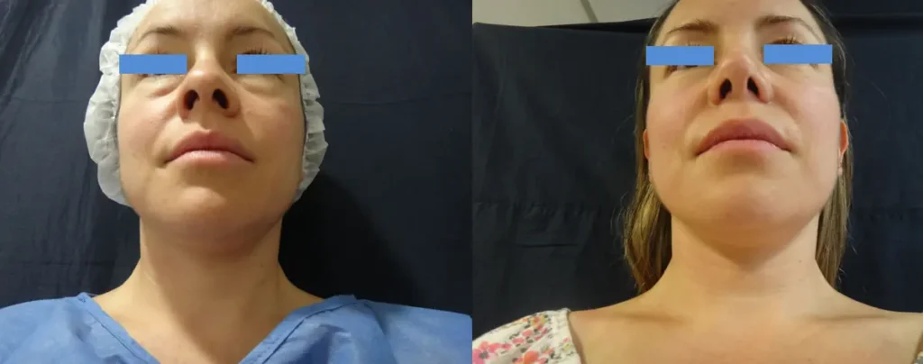 RINOPLASTIA-Y-BLEFAROPLASTIA-BOGOTA-COLOMBIA-1.2