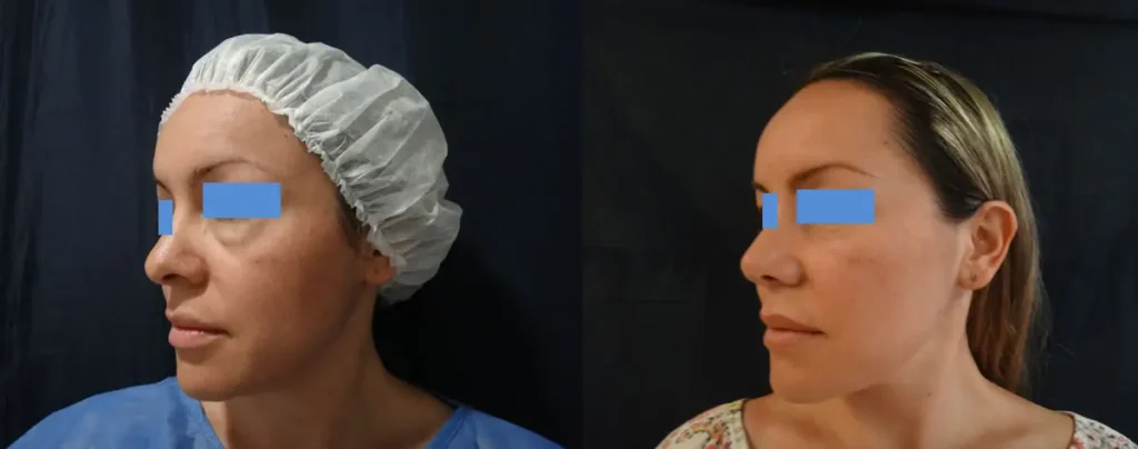 RINOPLASTIA-Y-BLEFAROPLASTIA-BOGOTA-COLOMBIA-1.3