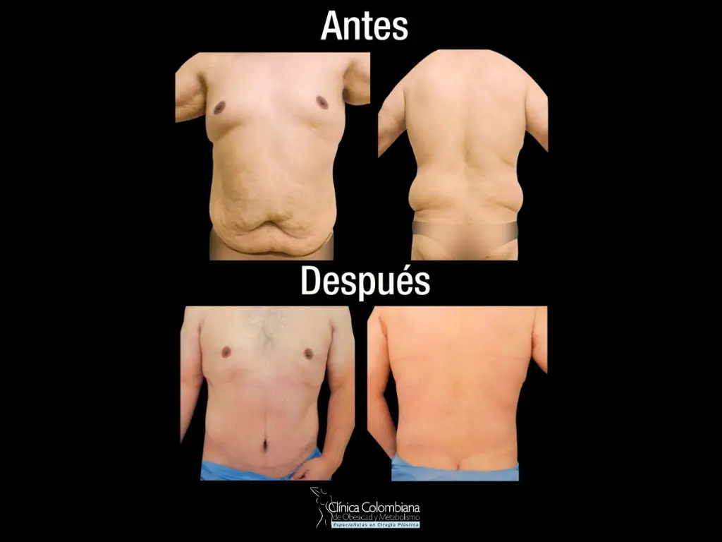 Abdominoplastia 360 para hombre