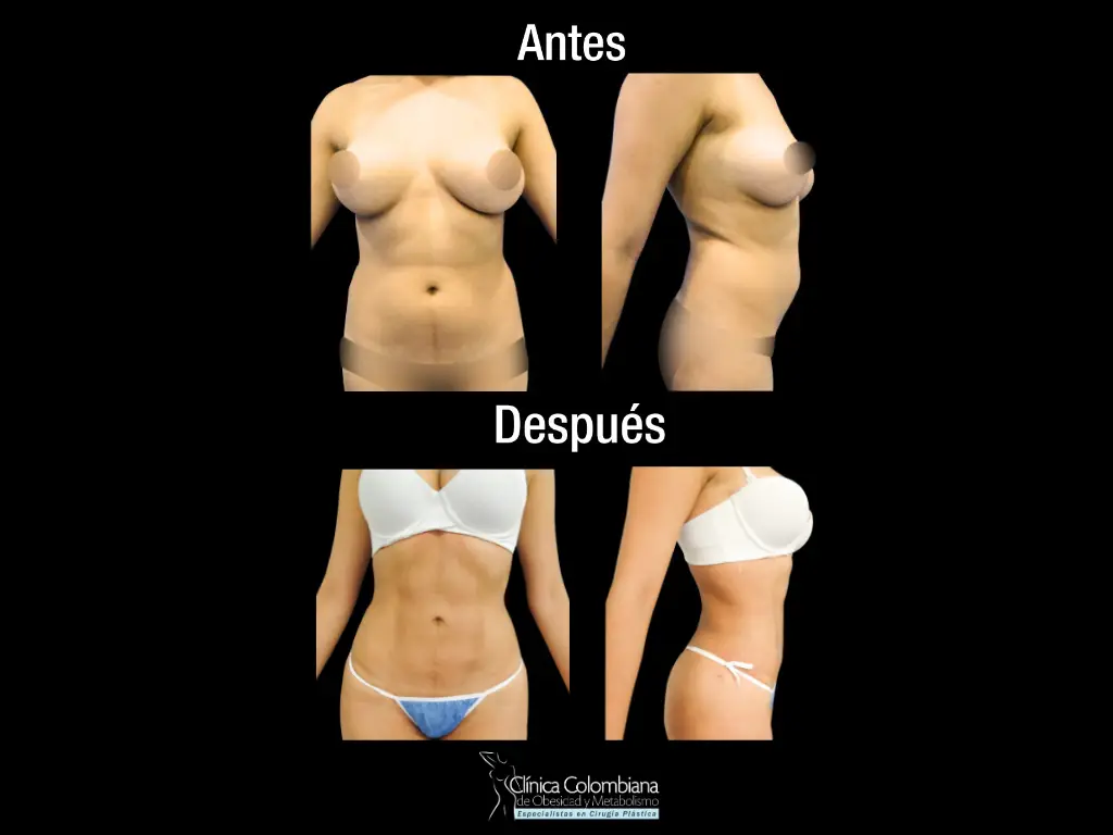 Antes y después de lipomarcación en mujeres