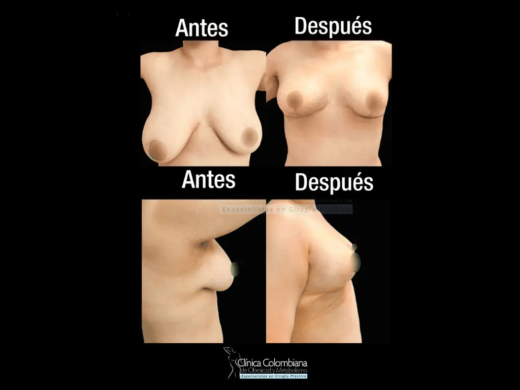 Antes y después de pexia mamaria sin implante