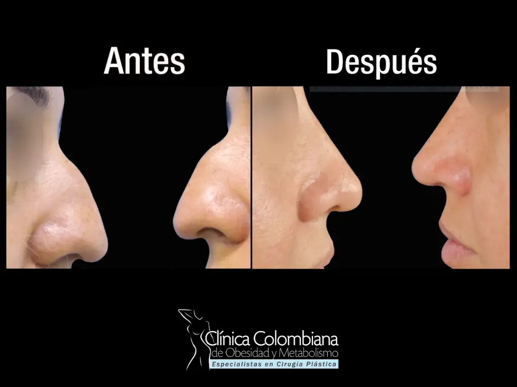 Antes y después de rinoplastia