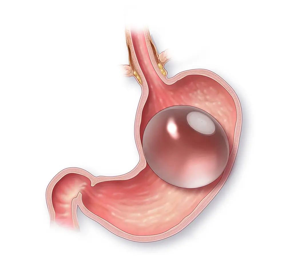 ilustracion de balon gastrico bariatrico